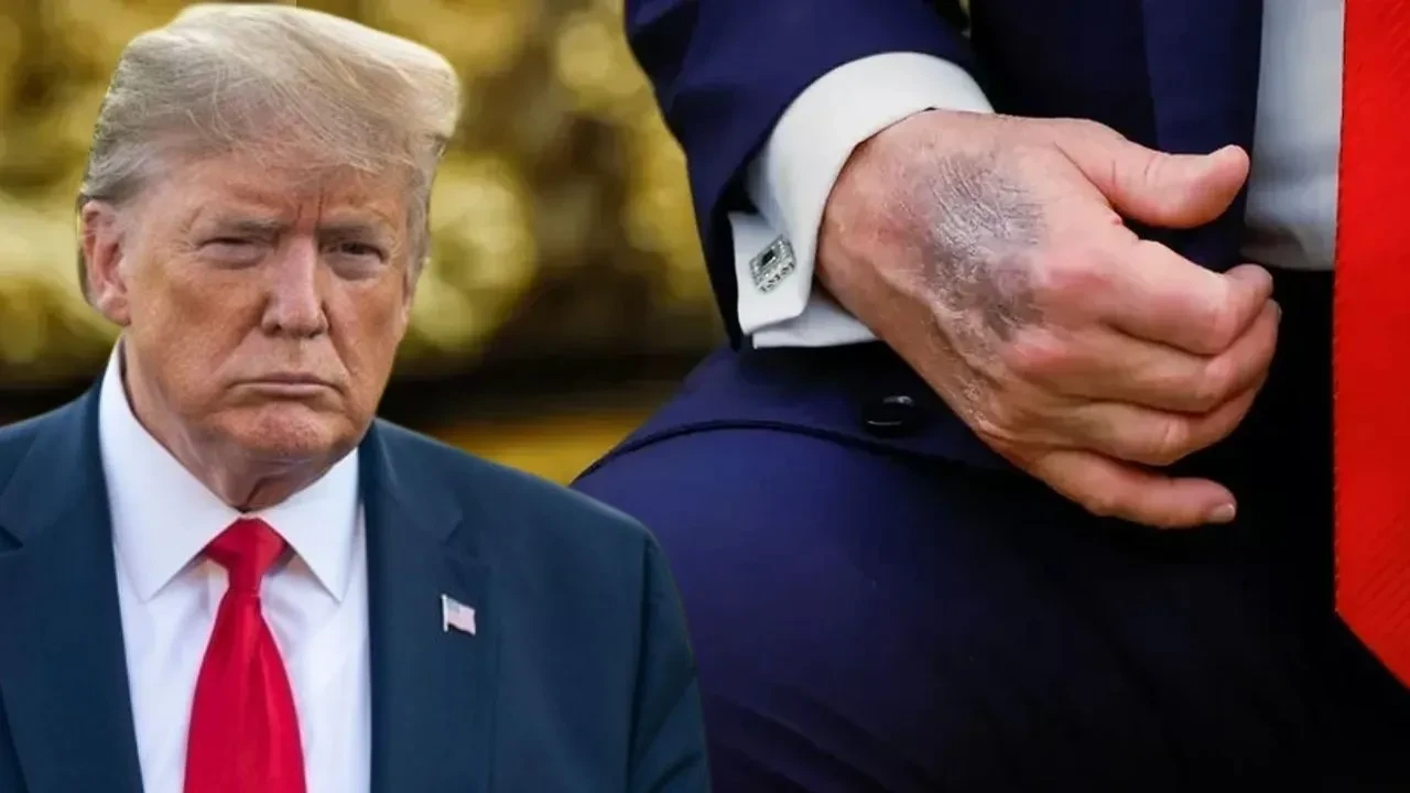Trump'tan sağlık durumu açıklaması: Boynundaki döküntü ve şişlik gündem olmuştu