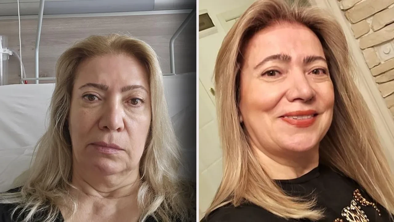 Yüzündeki kırışıklıklar için gitti, yüz felci geçirdi! Ağzı yamuldu, yüzü aşağıya sarktı 