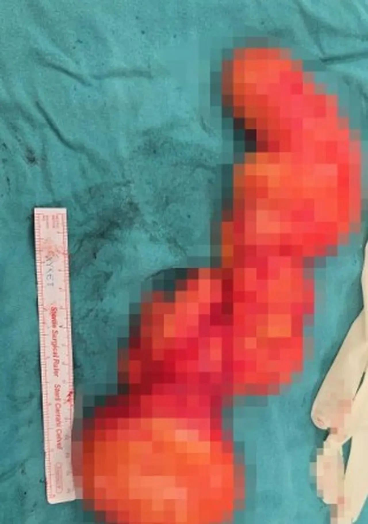 Doktorlar bile şaşkınlığını gizleyemedi! Sırtından dev bir kitle çıkarıldı