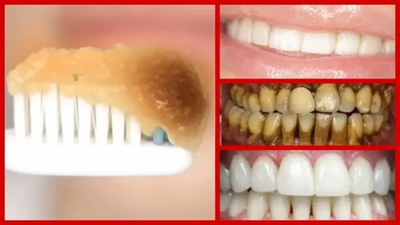 Sapsarı dişleri evde bembeyaz yapan karışım Hindistancevizi yağı ve zerdeçal! Deneyimleri aktarıyoruz