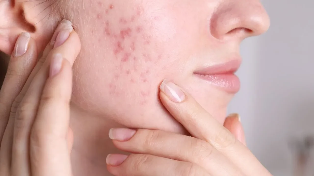 Doğum kontrol hapı sonrası oluşan erkek hormonu kaynaklı sivilceleri doğal yollarla geçirme rehberi!