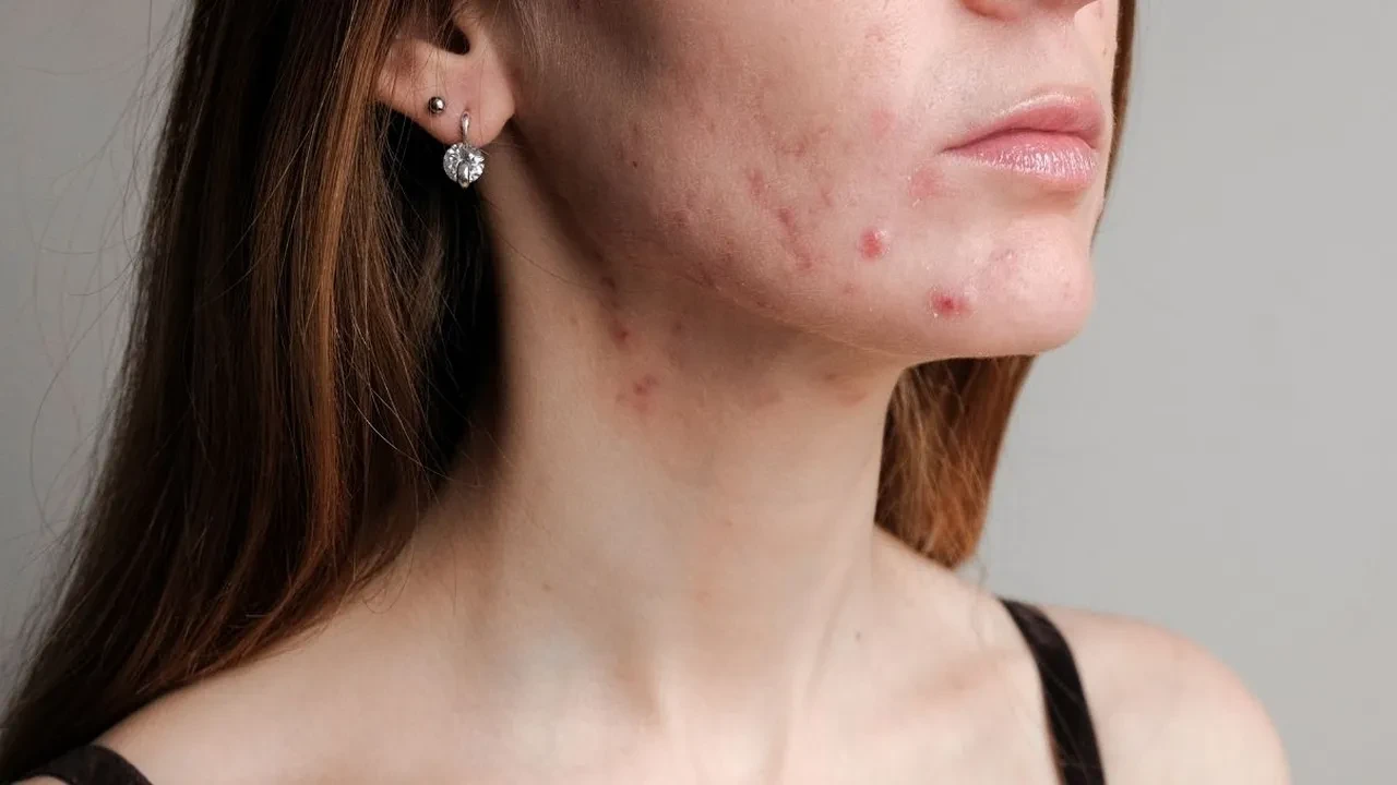 Doğum kontrol hapı sonrası oluşan erkek hormonu kaynaklı sivilceleri doğal yollarla geçirme rehberi!