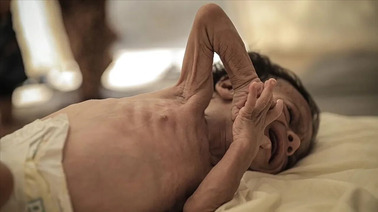 Son 24 saatte 4 çocuk öldü! Toplam can kaybı 700'ü aştı, ülkede kızamık salgını vakası 100 bine dayandı