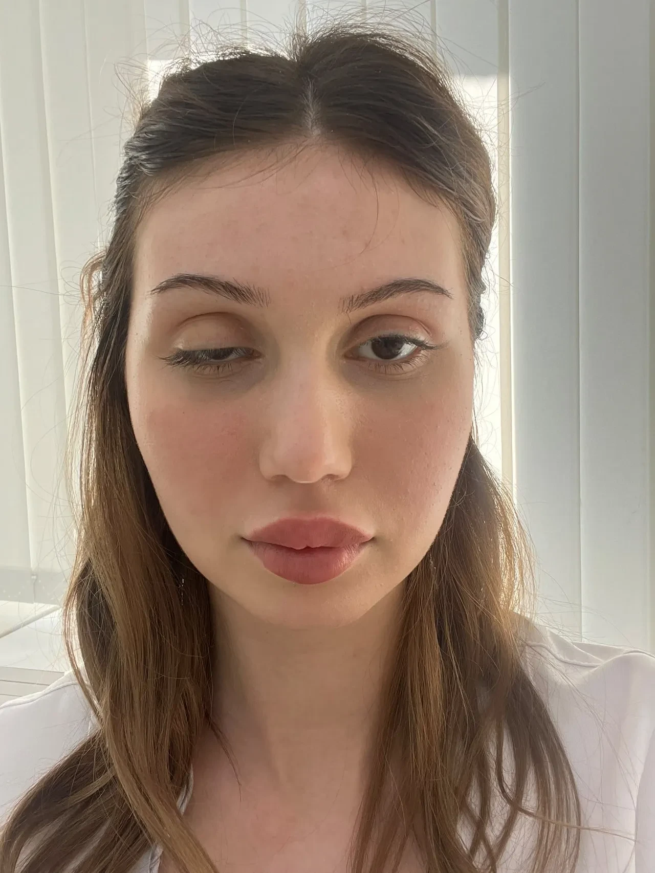 Düğününe 3 ay kala botoks yaptırdı! Hayatının şokunu yaşadı