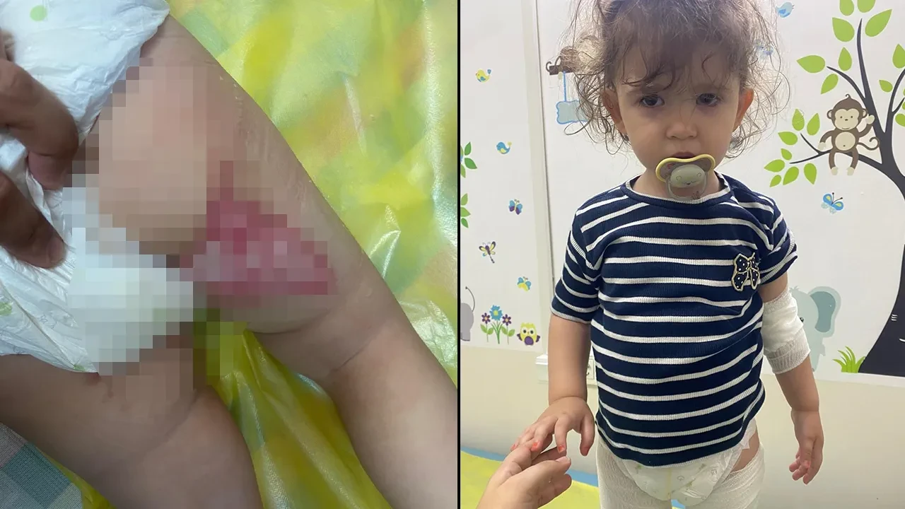 Restorandaki tereyağ gösterisi faciaya dönüştü: 2 yaşındaki çocuk ağır yaralandı