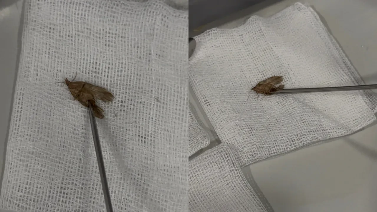 Kulağından canlı ‘Kelebek’ çıktı! İstanbul’da akıl almaz olay
