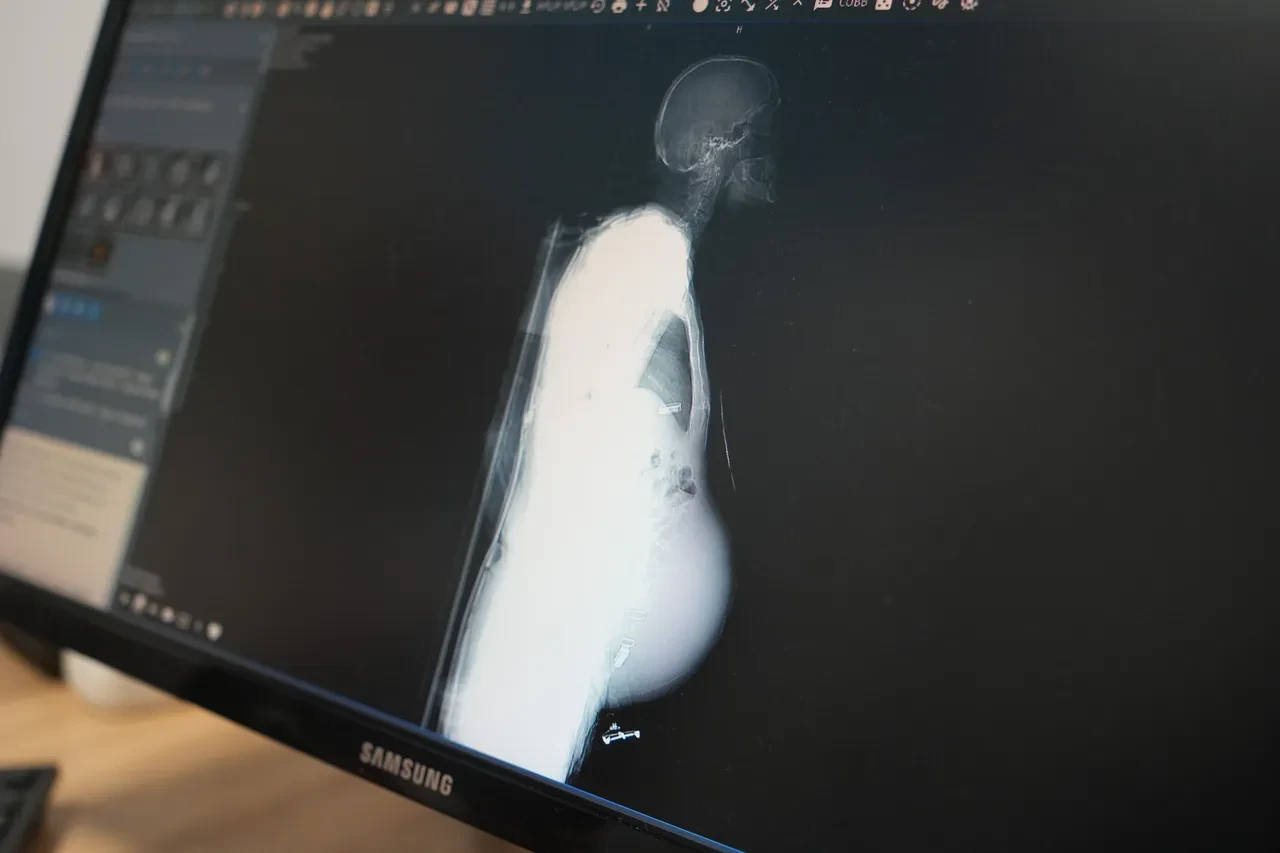 Doktorlar meslek hayatında ilk defa karşılaştı! Karnından çıkanlar şoke etti: Tam 6,5 kilo