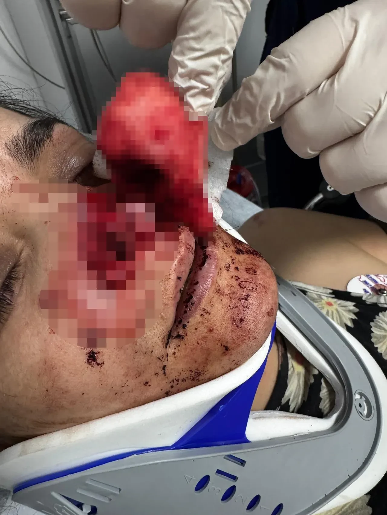 İki çocuğunun gözü önünde korkunç saldırı! Genç annenin burnunu ısırarak kopardı