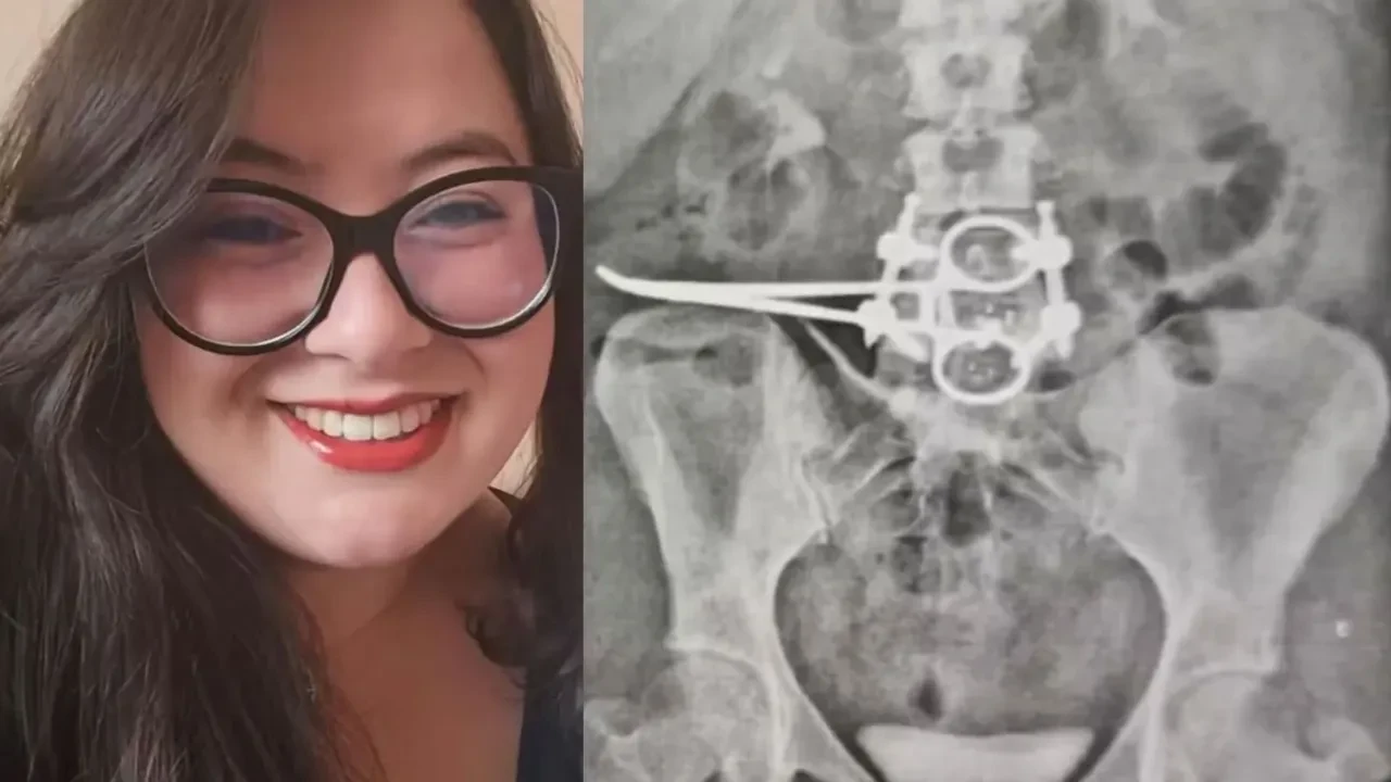 3 çocuk annesi kadının ameliyat sonrası yaşadığı kabus: Röntgen sonucu dehşete düşürdü