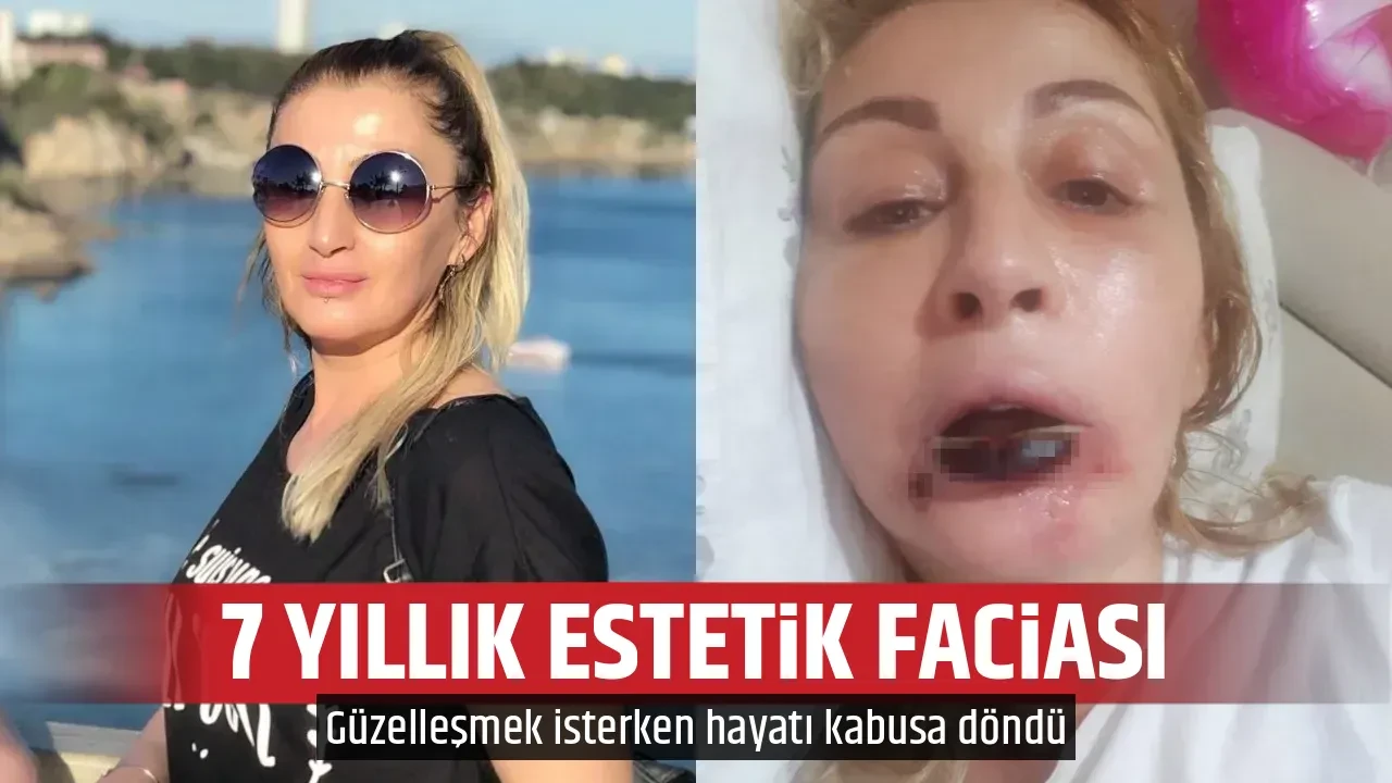 7 YILLIK ESTETİK FACİASI