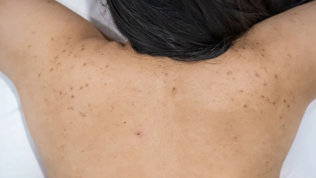 Egzama bir cilt hastalığı değil! Önce dahiliye sonra psikoloğa da gidin