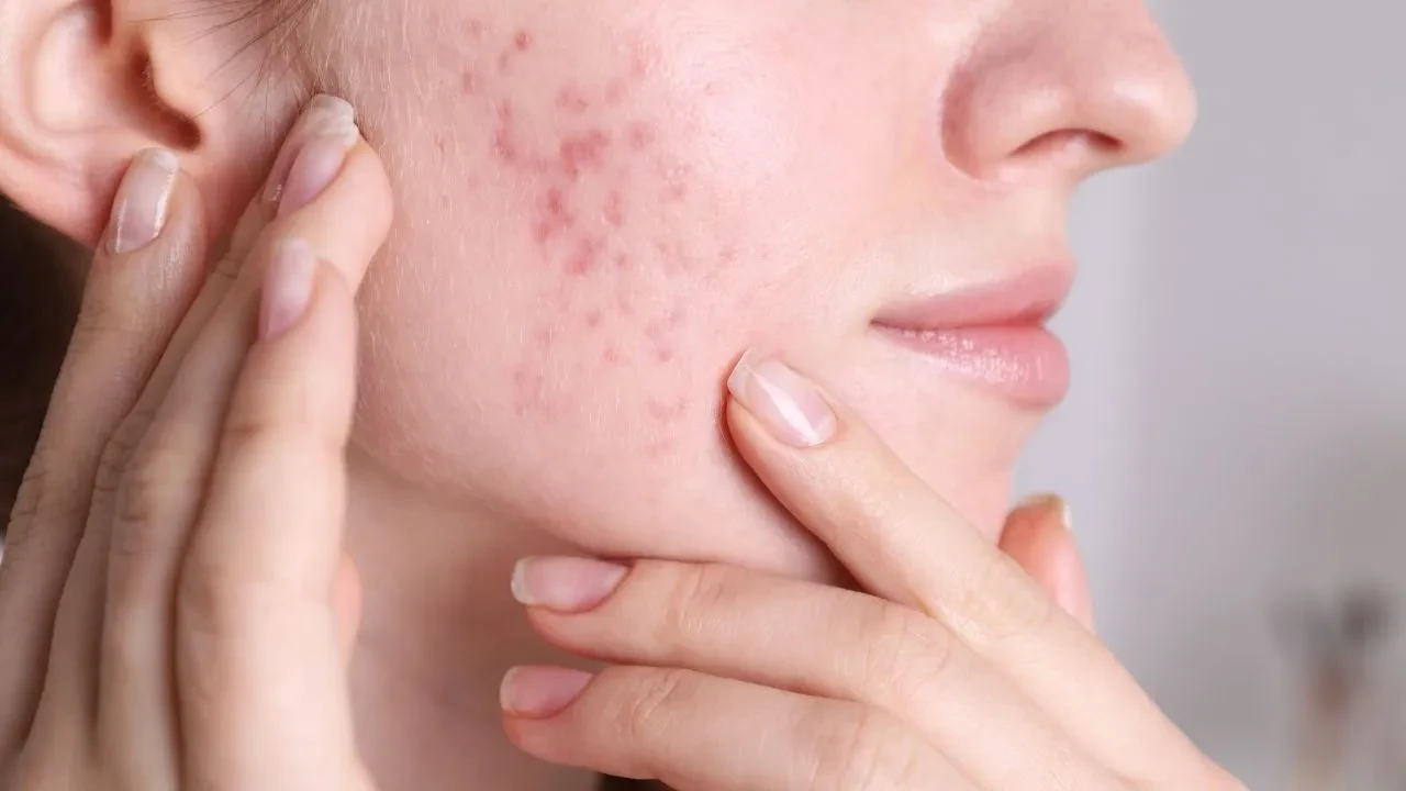 Dermatologdan öğrendim, cildim 1 haftada düzeldi! Cilt problemine göre doğal yüz maskesi bakım rutini