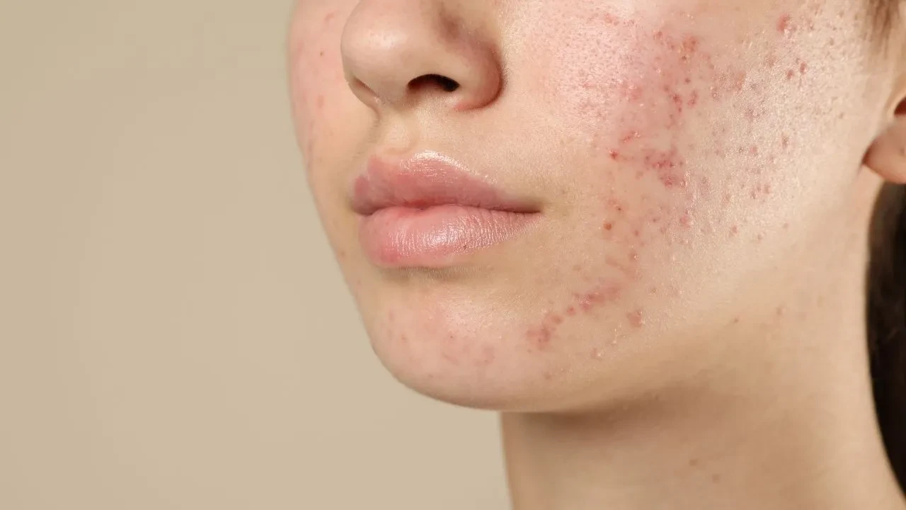 Dermatologdan öğrendim, cildim 1 haftada düzeldi! Cilt problemine göre doğal yüz maskesi bakım rutini