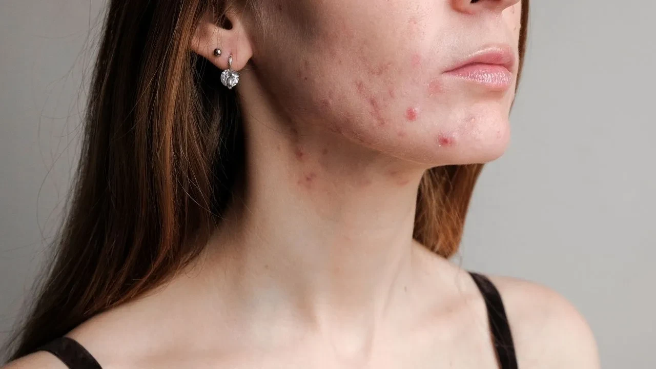 Dermatologdan öğrendim, cildim 1 haftada düzeldi! Cilt problemine göre doğal yüz maskesi bakım rutini