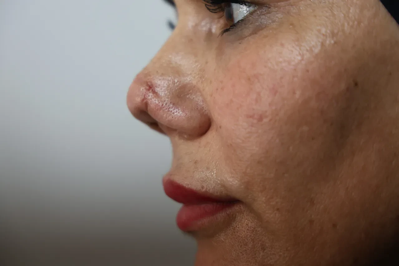 Hatalı ameliyat kâbusu: Kırılan burnu için 4 kez bıçak altına yattı, hayatı karardı