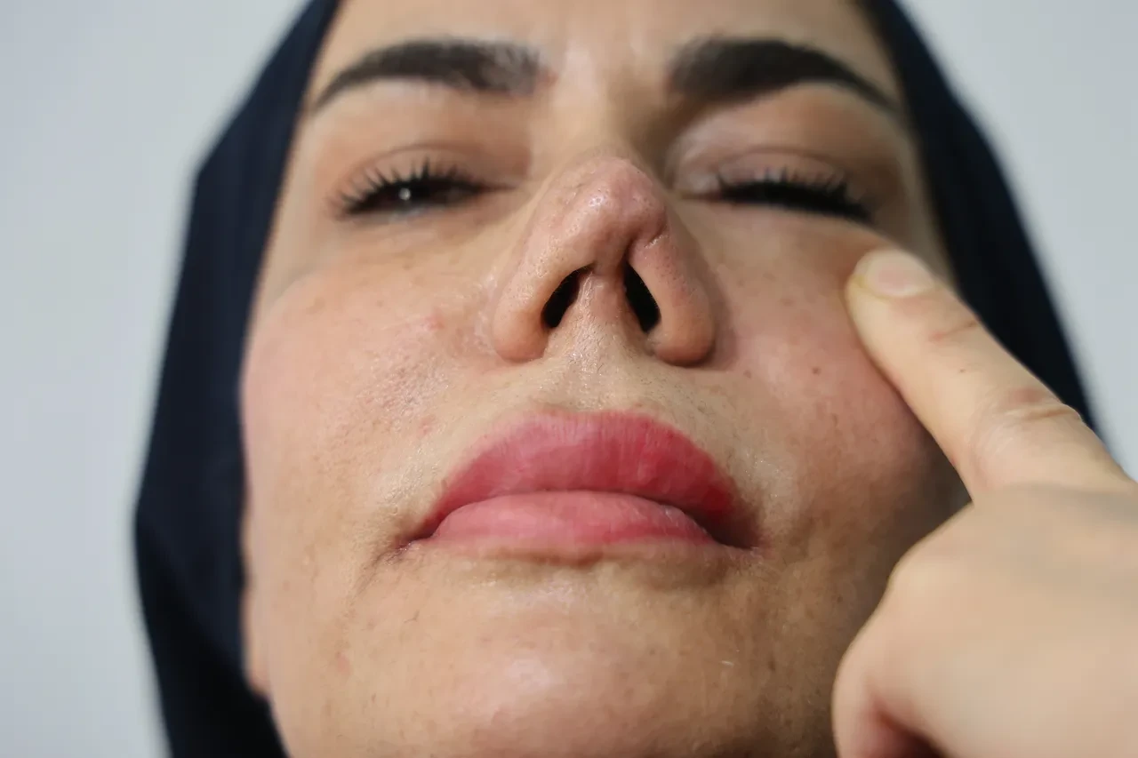 Hatalı ameliyat kâbusu: Kırılan burnu için 4 kez bıçak altına yattı, hayatı karardı