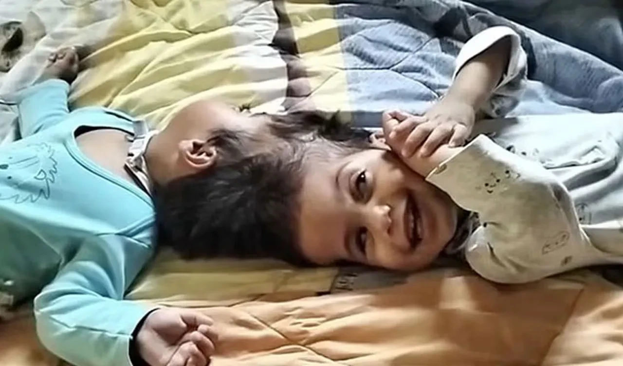 Başından yapışık ikizler 5. ameliyat sırasında yaşam mücadelesini kaybettiler