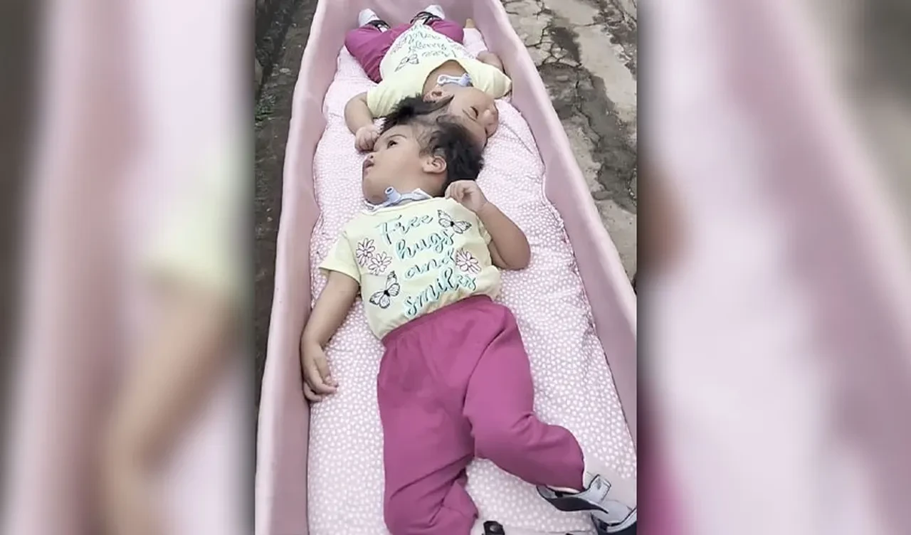 Başından yapışık ikizler 5. ameliyat sırasında yaşam mücadelesini kaybettiler