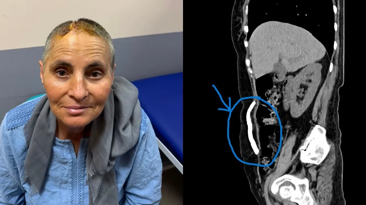 Kafatası kemiklerini 8 ay karnında taşıdı! Manisalı kadın mucize ameliyatla sağlığına kavuştu
