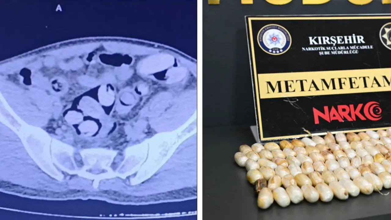 Midesini uyuşturucu taşıma aracı olarak kullandı! Çıkan miktar şoke etti