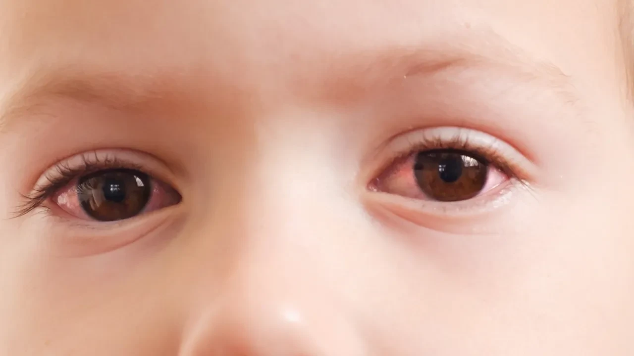 Çocuğun gözü kızardıysa sakın bunu yapmayın! Ebeveynlerin yaptığı hata ortaya çıktı