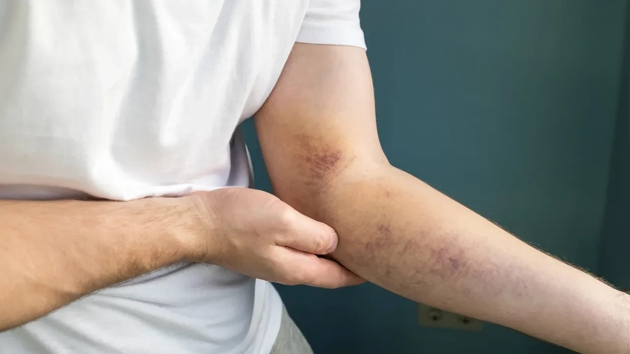 Lipödem belirtileri nelerdir? Vücudunuzda kendiliğinden ortaya çıkan morluklara dikkat!