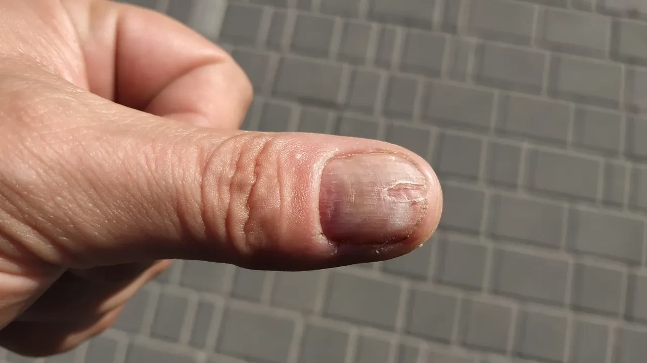 Tırnaktaki çizgi ve lekeler hastalık habercisi mi? Uzmanı tek tek açıkladı