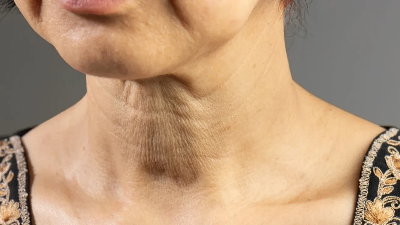 Boyun ve çene bölgesi nasıl sıkılaşır? Yaş ilerledikçe değişen bölgeye dikkat