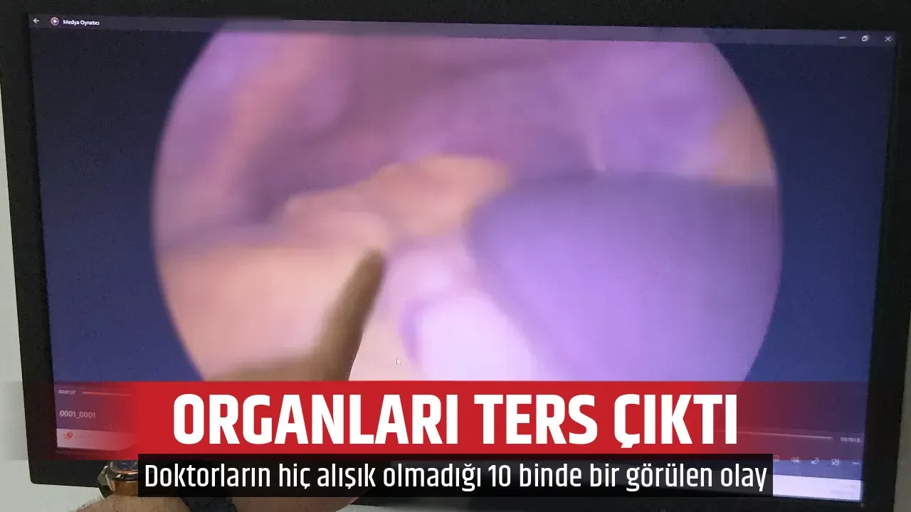 ORGANLARI TERS ÇIKTI