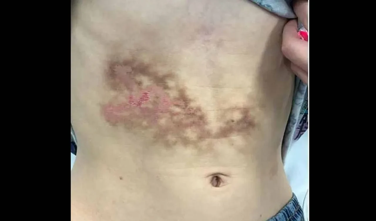 Dizüstü bilgisayarı karnına koyup saatlerce kullandı, hastanelik oldu