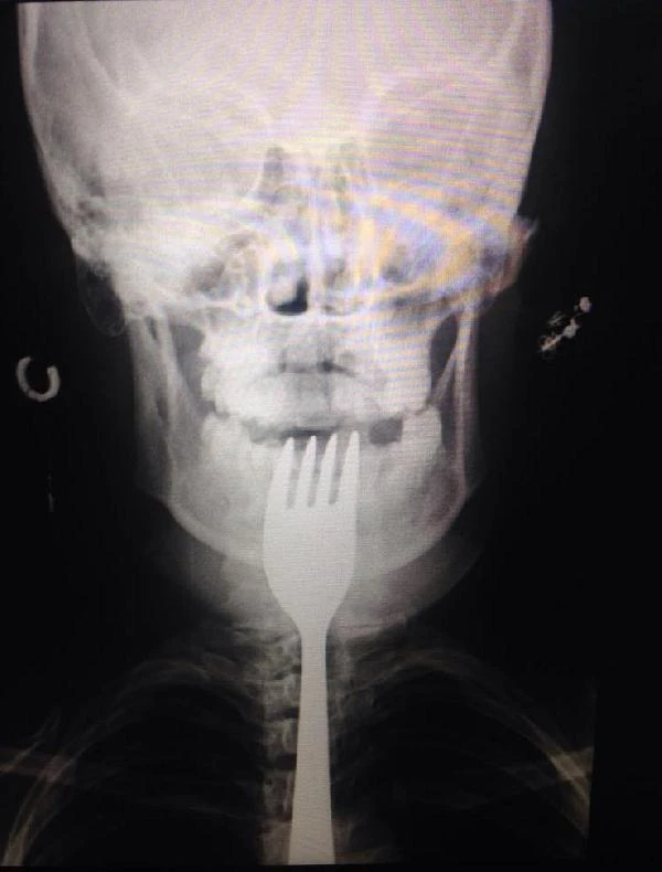 Çürük dişini karıştırdığı çatal boğazına kaçtı