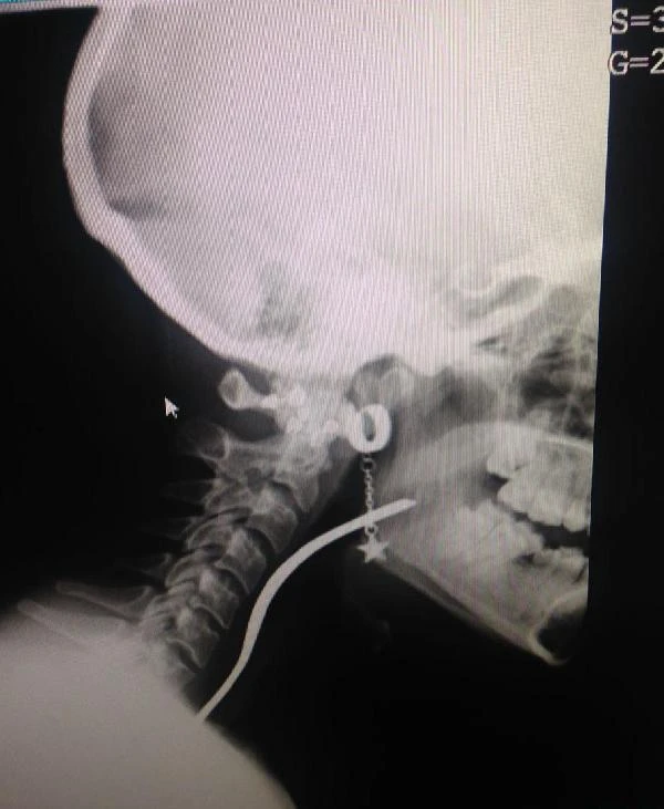 Çürük dişini karıştırdığı çatal boğazına kaçtı