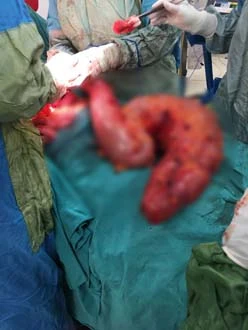 Karnından otomobil lastiği büyüklüğünde tıkanmış bağırsak çıkarıldı