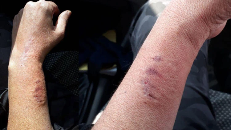 Polis memurunun kolunu ısıran HDP'li vekil hakkında soruşturma başlatıldı!