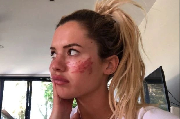 Güzellik uğruna geçici körlük yaşadı yüzünde yaralar çıktı