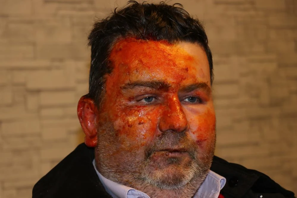 Uyurken dehşeti yaşadı: Kardeşi tarafından yüzü yakıldı