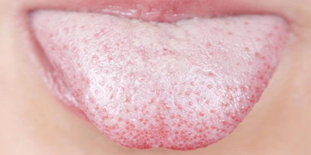 Dil Mantarı Nedir? Dil Mantarı Neden olur?