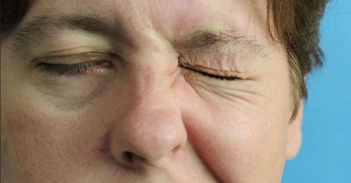 Yüz Felci Nedir? Yüz Felci Neden Olur? Yüz Felci Nasıl Tedavi Edilir?