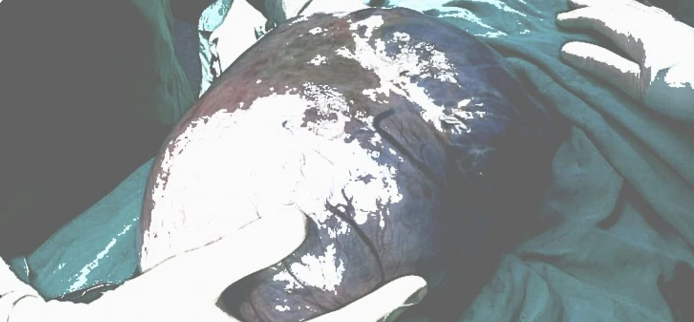 Karın ve mide ağrısı ile gelen hastadan 7 buçuk kilogramlık kitle çıktı