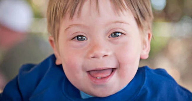 Down Sendromu Nedir? Down Sendromu Nasıl Anlaşılır? Down Sendromu Çocuklarda Nasıl Olur?