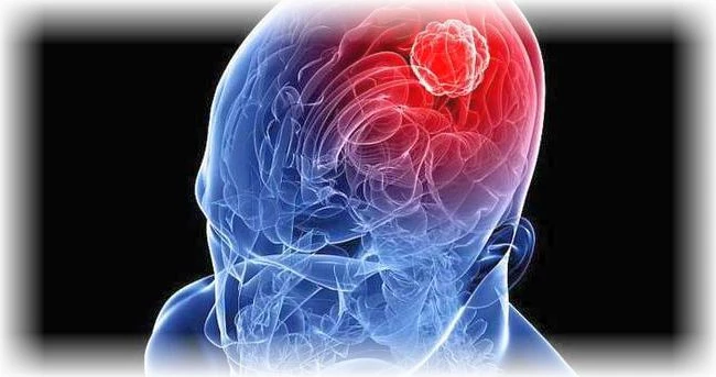 Beyin tümörü hastaları ne kadar yaşar,  Beyin tümörü neden olur?