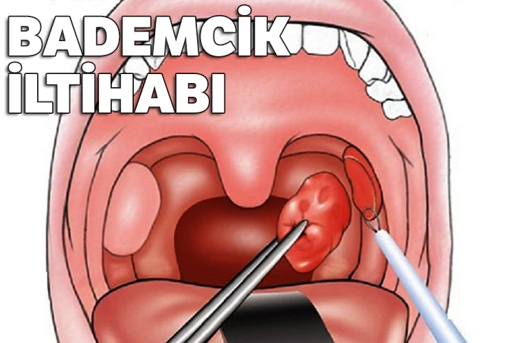 Kriptik Tonsillit, Bademcik İltihabı Nedir Nasıl Geçer