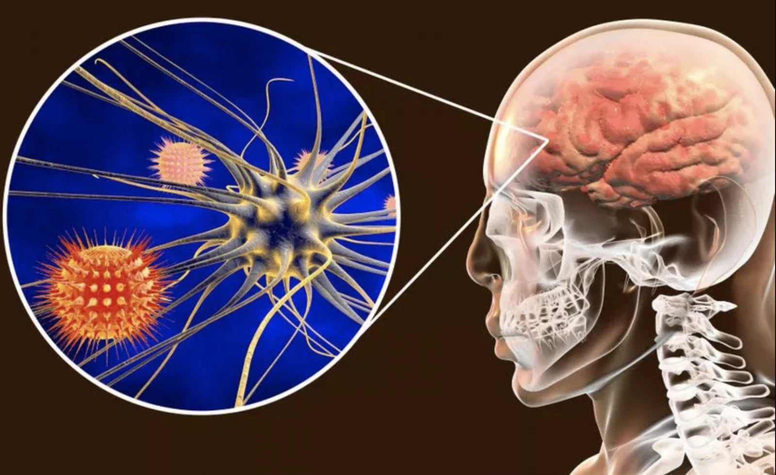 Beyin Kanaması Nedir? Beyin Kanaması Neden Olur?