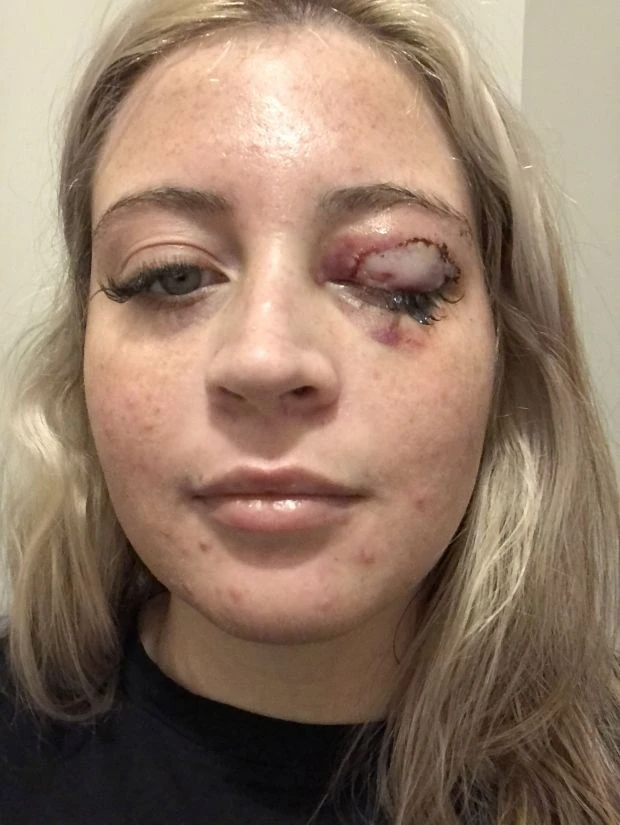 Kirpik taktırmak isterken köpek saldırdı göz kapağından oldu