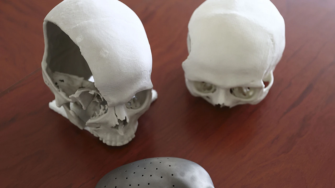 Yapay kafatası ile yeniden hayata gülümsedi