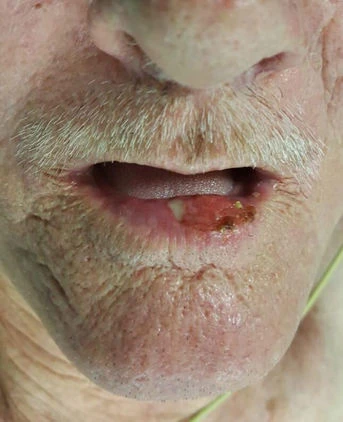 Dudağındakini yara sandı, önemsemedi! Gerçek şoke etti!