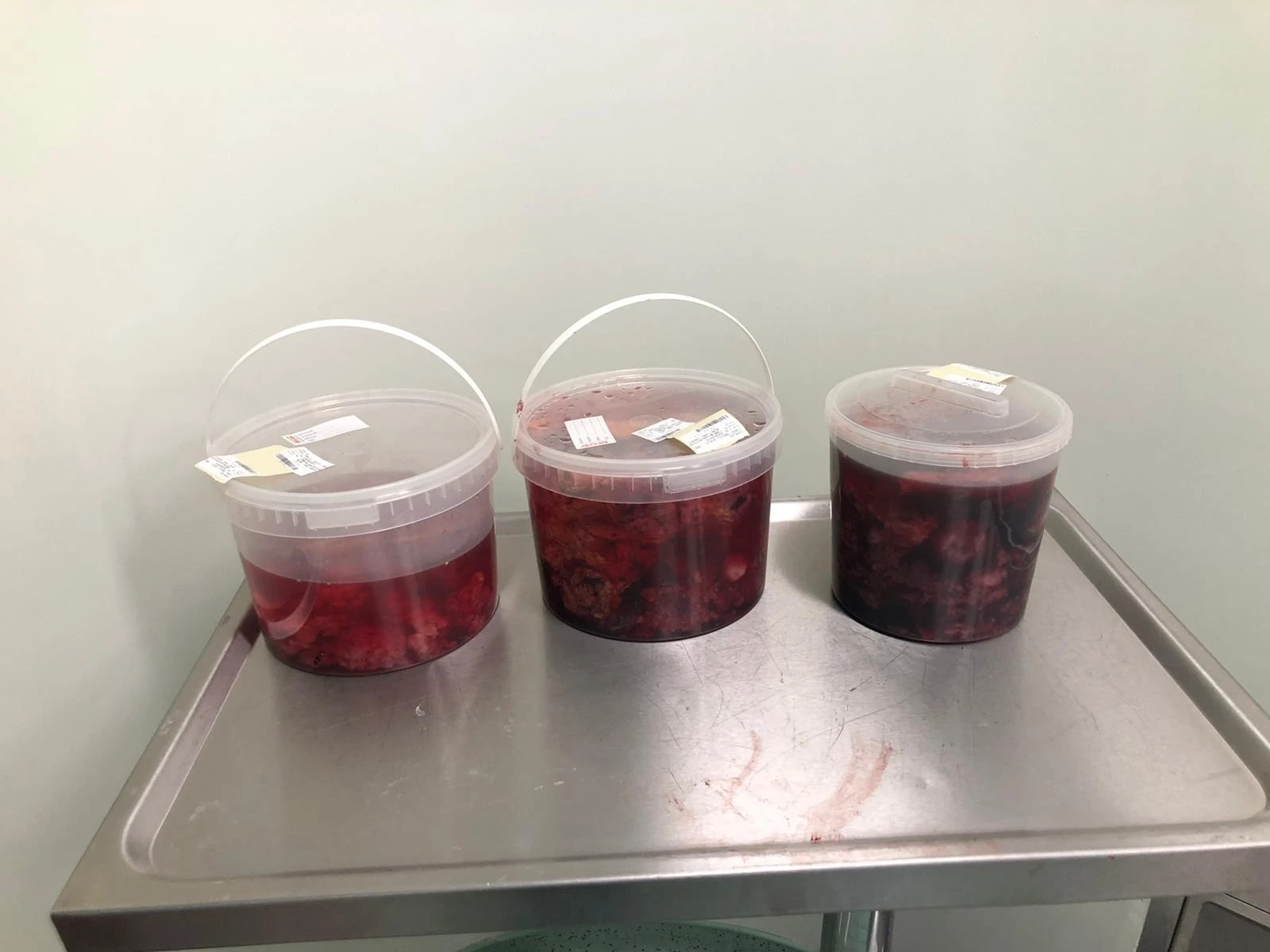 Kilo aldığını sandı, karnından futbol topu büyüklüğünde ur çıktı