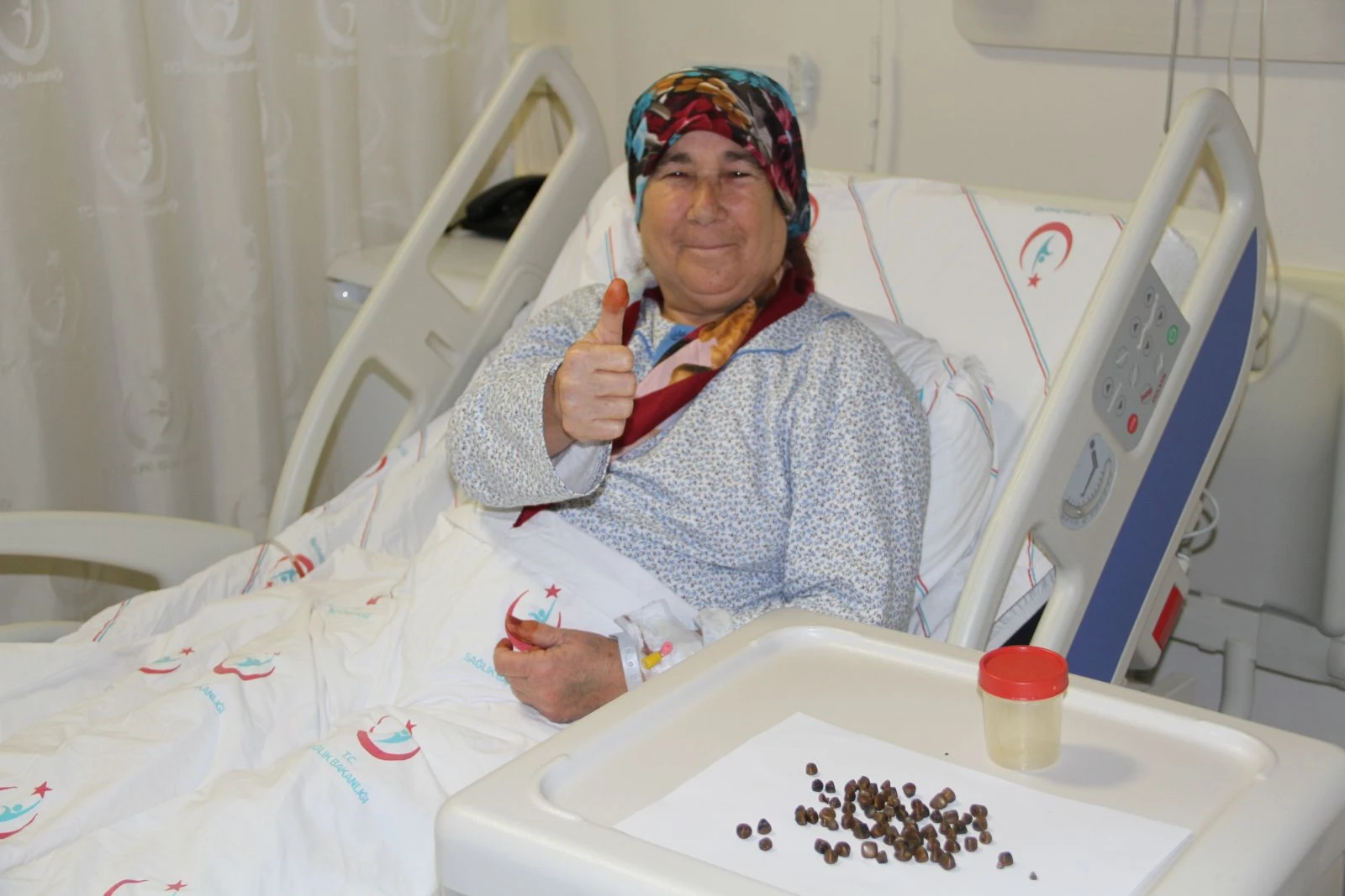 17 yıldır karın ağrısı çeken kadının safra kesesinden 86 parça taş çıkarıldı