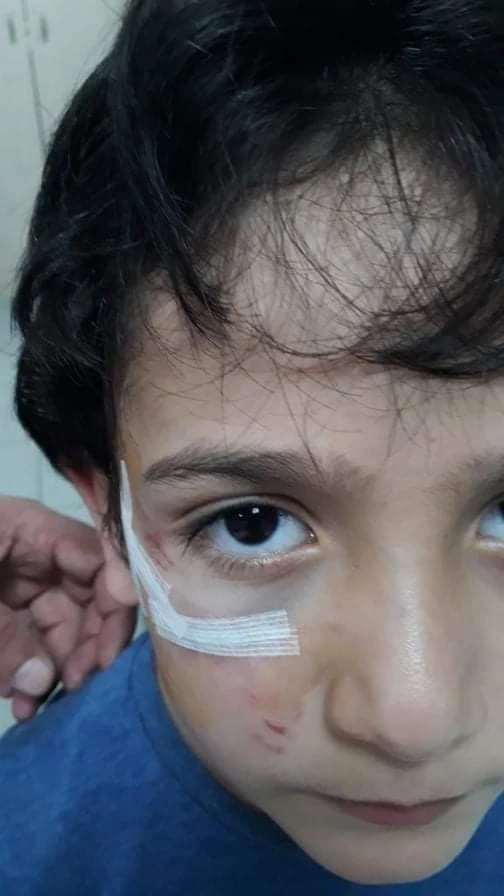 Sokak köpeği 8 yaşındaki Mehmet'in yanağını koparıyordu