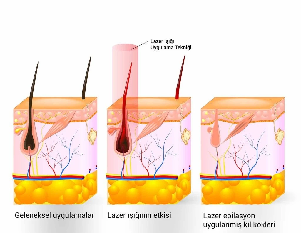 Buz lazer ile yaza ışıl ışıl bir ciltte girmeye hazır mısınız?